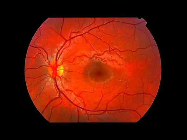 Retina